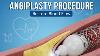 Angioplasty Procedure More Explanation For Request Of Our Subscriber
