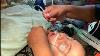 Nasogastric Ng Tube Insertion Safe Medical Procedure For Learning