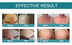 TDDS Plasma Pulse Skin Regeneration Sterilization Repair Machine Salon Spa Use