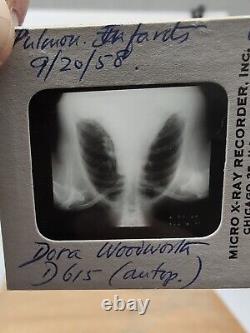 Vintage Photo Slides Kodachrome Pathology Radiology X-ray Medical Education 1950